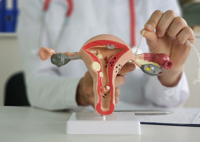 Study and Treatment of Polycystic Ovary Syndrome (PCOS)